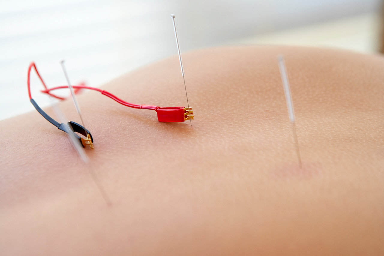 ElectroAcupuncture